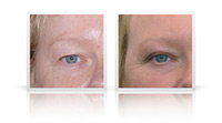 Combination of upper and lower eyelid blepharoplasty surgery.