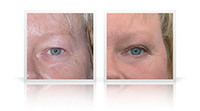 Combination of upper and lower eyelid blepharoplasty surgery.