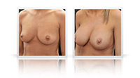Breast enlargement, areolar scar area.