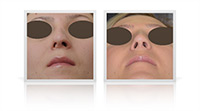 Tertiary open tip rhinoplasty following to primary interventions.