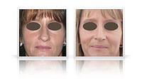 primary reduction rhinoplasty, nasal tip and bridge.