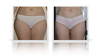 VASER liposelection.