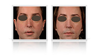 Open tip rib graft reconstructive rhinoplasty.