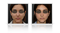 Primary open tip reduction rhinoplasty combined with chin reduction